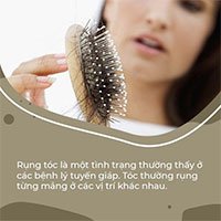 Tại sao rụng tóc lại liên quan đến rối loạn chức năng tuyến giáp?