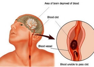 Thay đổi mạch thần kinh não dẫn đến đau ma chi　