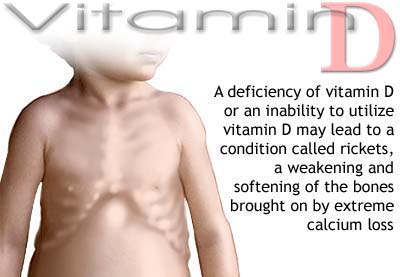 Thiếu hụt vitamin D ở trẻ
