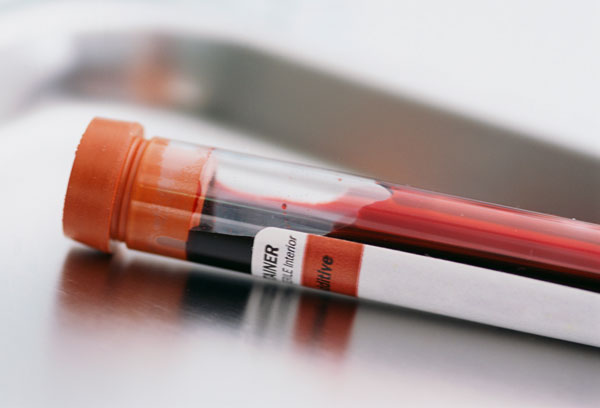Thử máu có thể giúp phát hiện sớm ung thư phổi