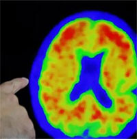 Thuốc donanemab - đột phá trong việc điều trị bệnh Alzheimer