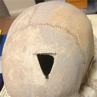 Tìm thấy hộp sọ bị khoan lỗ 3.200 năm trước ở Thổ Nhĩ Kỳ