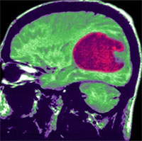 Trí tuệ nhân tạo có thể điều trị u não nhanh và chính xác hơn