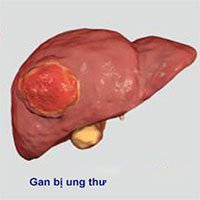 Ung thư gan Việt Nam xếp thứ 4 thế giới, giờ có thể triệt u không cần phẫu thuật