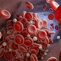 Vì sao máu đông khi nhiễm Covid-19?