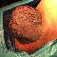 Video: Em bé tự chui đầu ra khỏi bụng mẹ