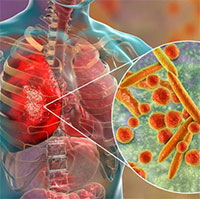 Viêm phổi do Mycoplasma: Nguyên nhân,triệu chứng và cách điều trị